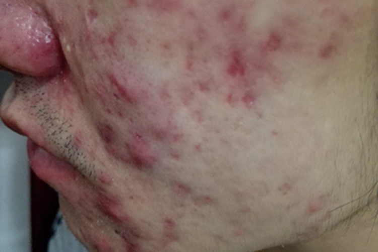 聚合性痤疮面部结节图