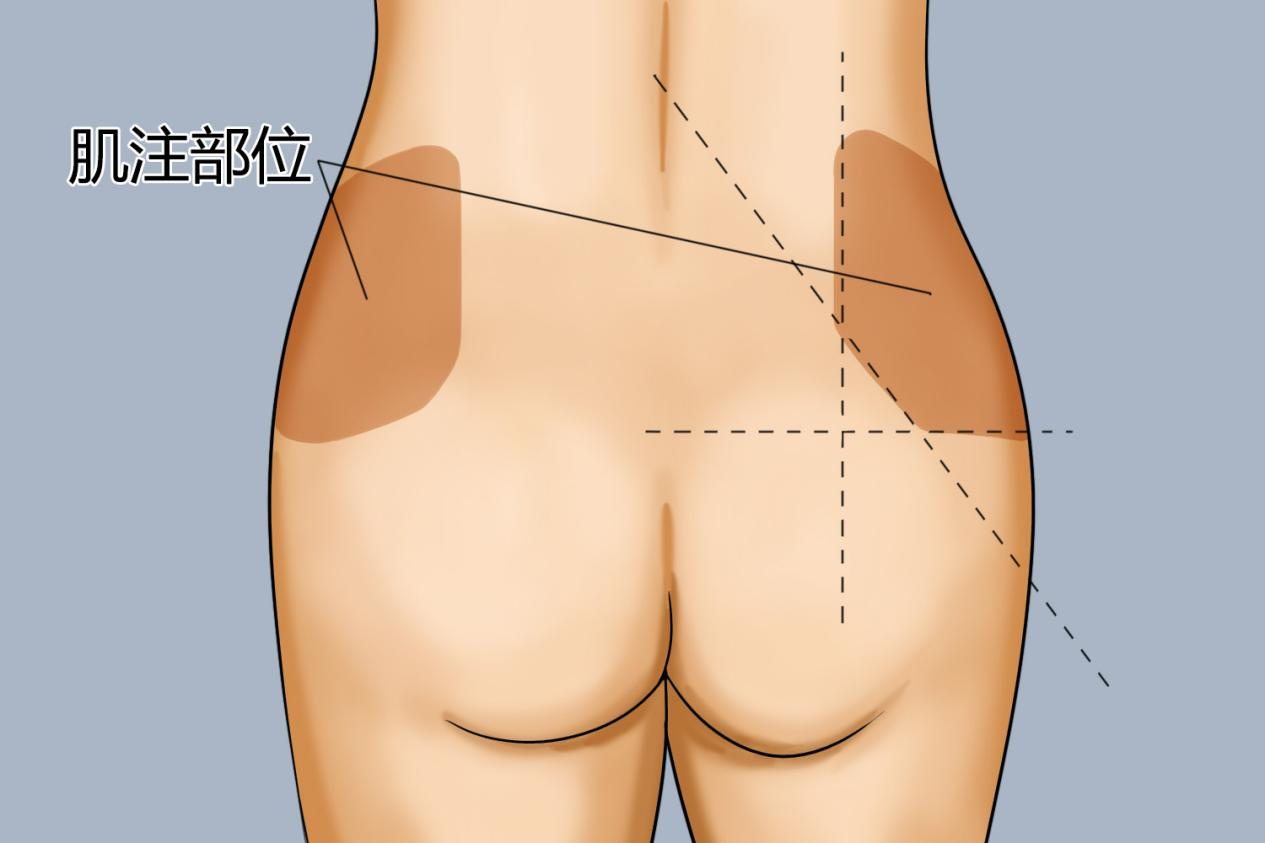 臀中肌十字定位法图图片