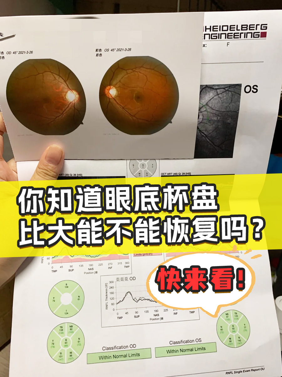你知道眼底杯盘比大能不能恢复吗？快来看！