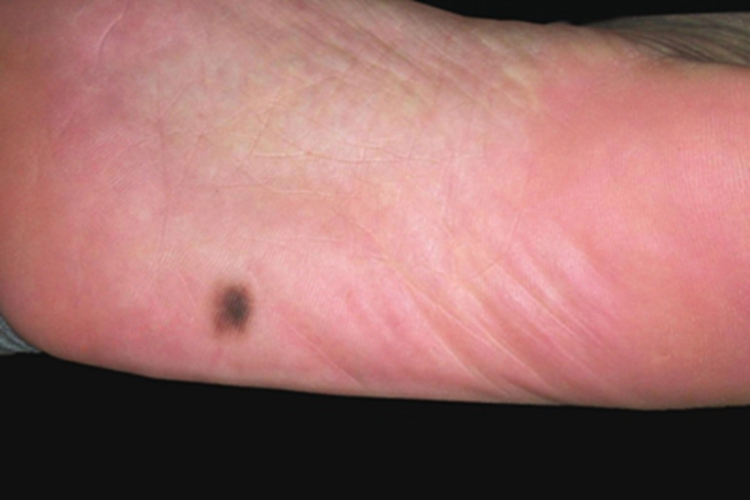 黑素细胞痣脚底黑斑图 黑素细胞痣脚底黑斑图