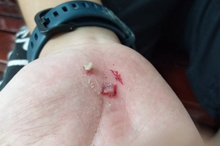 跌伤手掌症状图