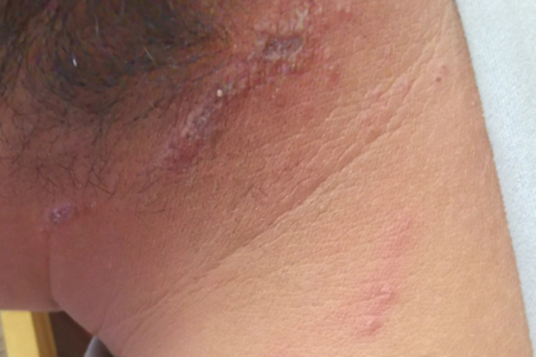 隐翅虫皮炎侧颈红斑脓疱图