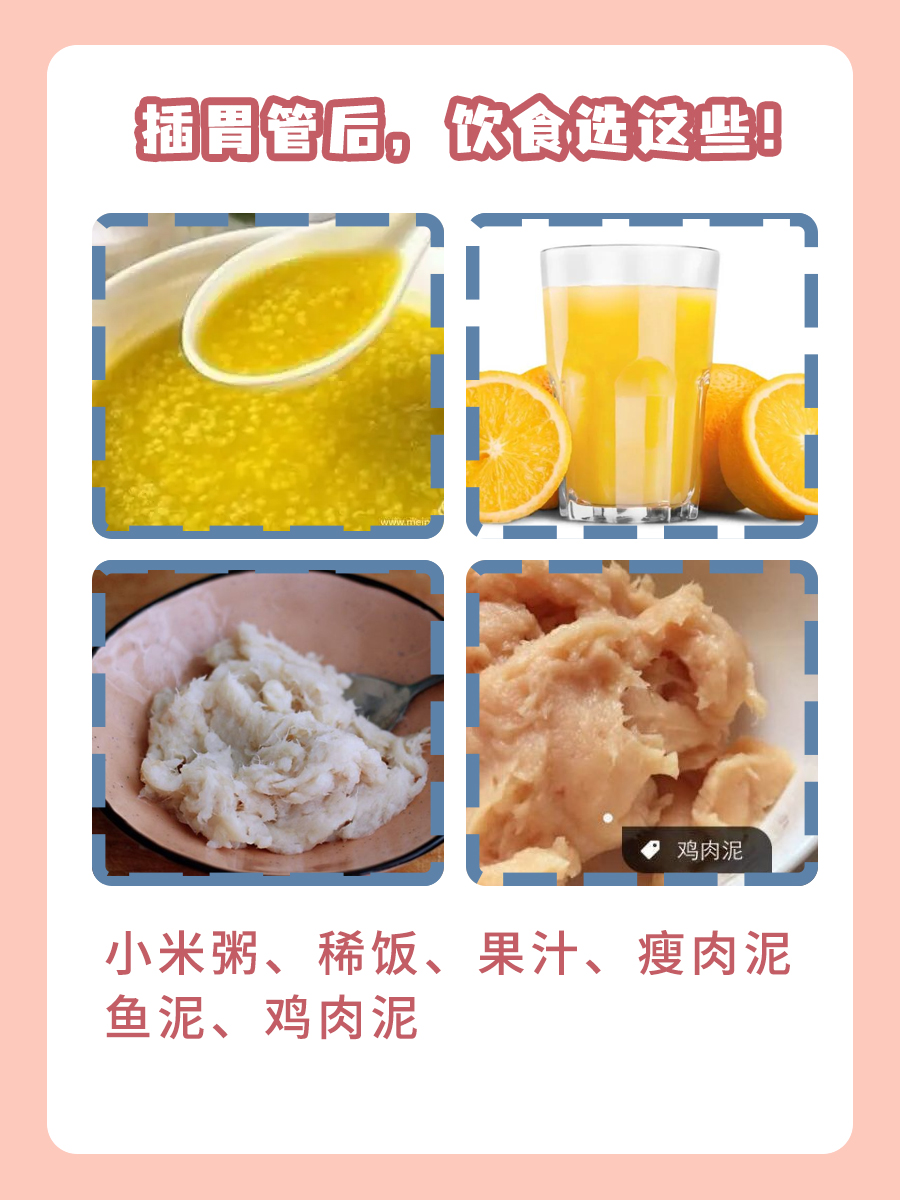 胃管与鼻饲管，一文读懂两者区别！
