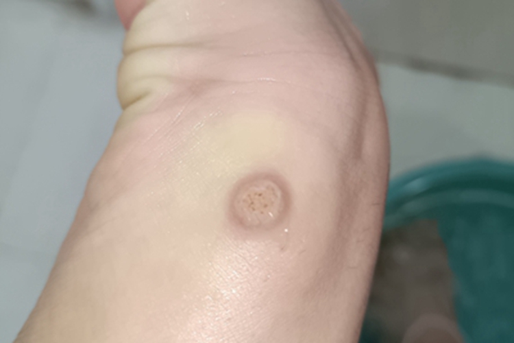 疣脚背疙瘩图 疣脚背疙瘩图