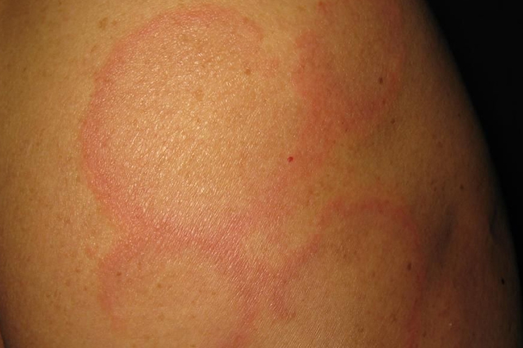 亚急性皮肤型红斑狼疮图 亚急性皮肤型红斑狼疮图