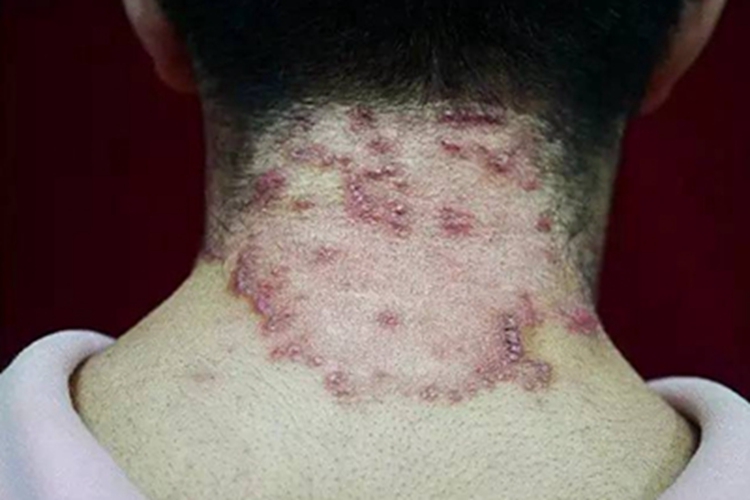 匍行性穿通性弹力纤维病症状图 匍行性穿通性弹力纤维病症状图