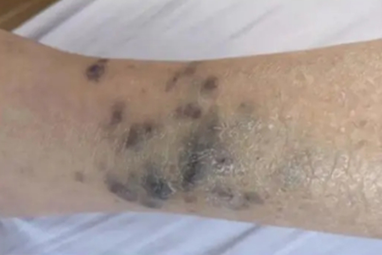 腿部卡波西肉瘤图