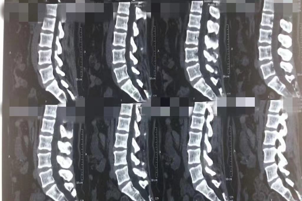 正常腰椎CT图