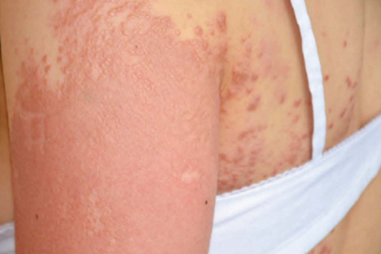 结节型黏液水肿性苔藓胳膊症状图