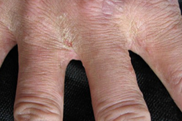 疥疮手指缝起小疙瘩图