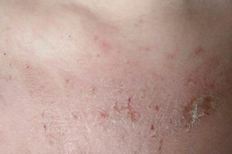 接触性皮炎胸部结痂图 接触性皮炎胸部结痂图