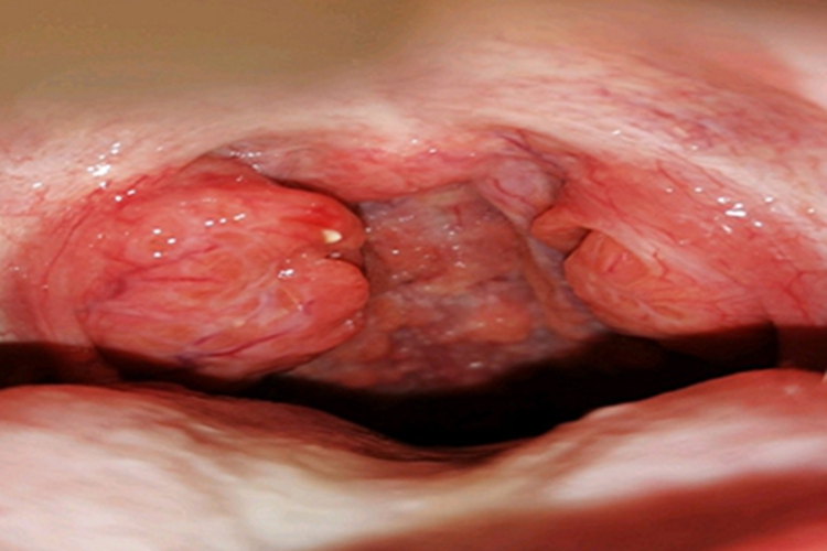 急性滤泡性扁桃体炎红肿图