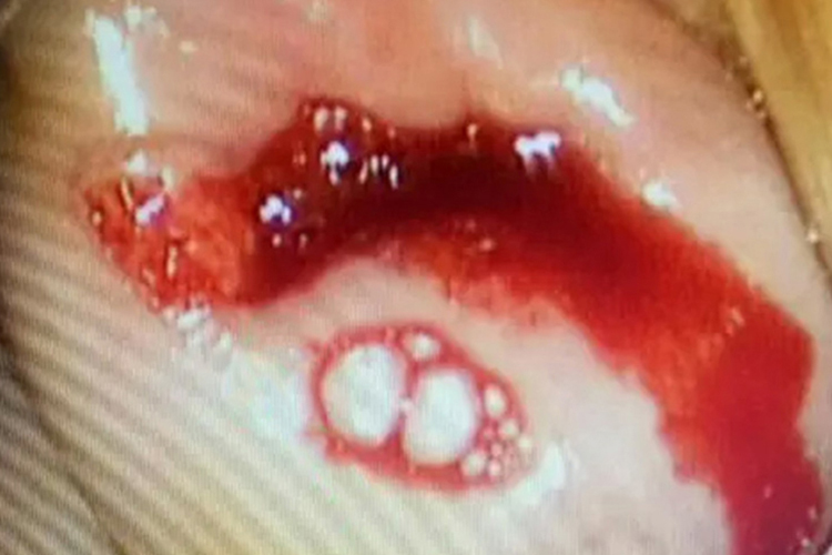 宫颈癌轻度出血内镜图 宫颈癌轻度出血内镜图