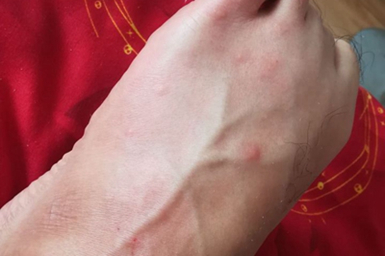 跳蚤叮咬脚背长红疙瘩图 跳蚤叮咬脚背长红疙瘩图