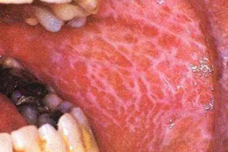 口癣嘴巴里面有白色条纹图