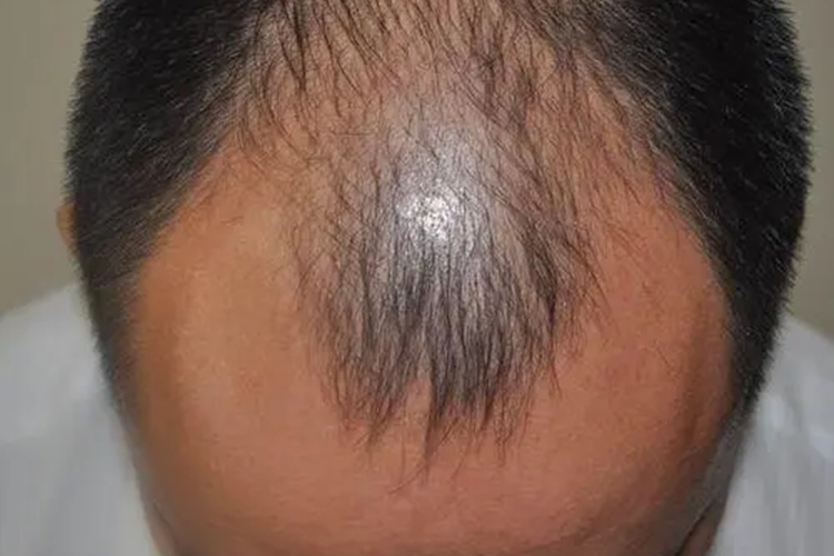 男性脂溢性脱发Ⅴ级图 男性脂溢性脱发Ⅴ级图