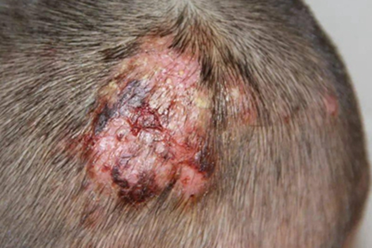 脓癣头部脓包图