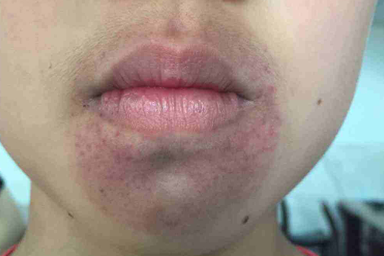 小孩嘴巴周围一圈紫癜图