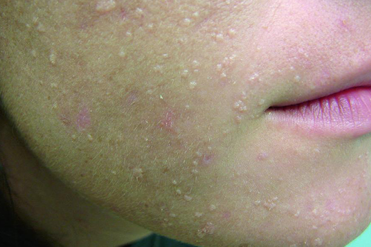 艾滋病面部扁平疣图