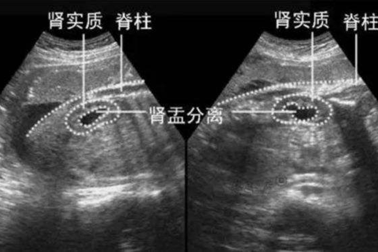 生理性肾盂分离图 生理性肾盂分离图