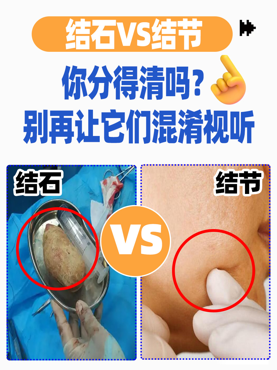 结石VS结节，你分得清吗？别再让它们混淆视听