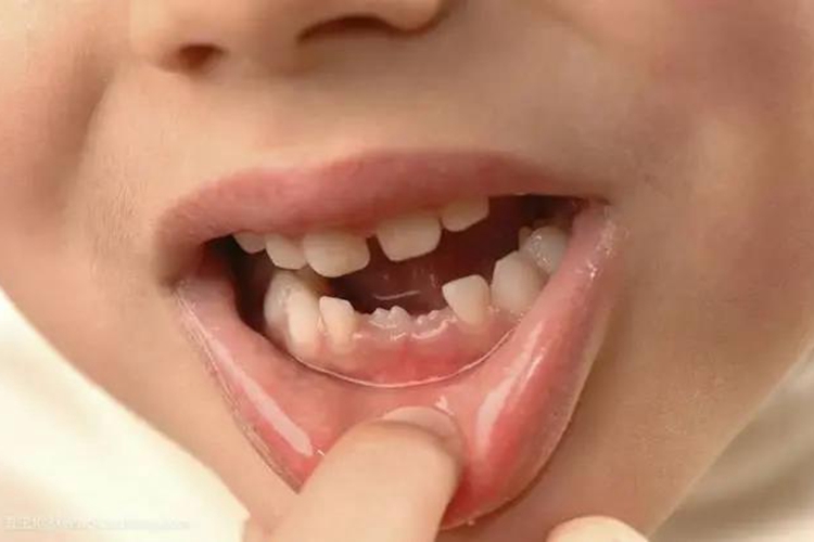 缺钙牙齿发育缓慢图 缺钙牙齿发育缓慢图