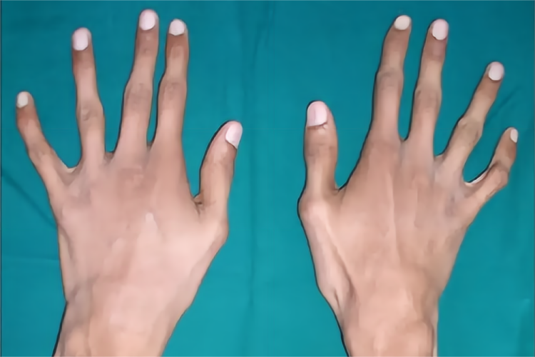 马方综合征蜘蛛指图 马方综合征蜘蛛指图