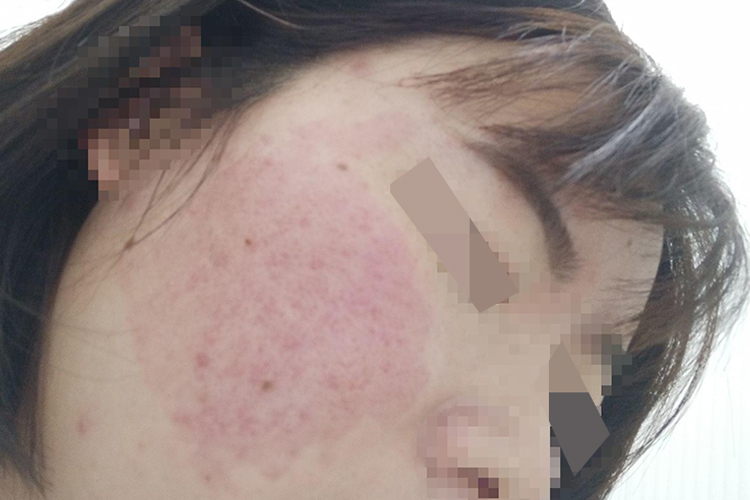 激光祛痘印第7-10天恢复图 激光祛痘印第7-10天恢复图