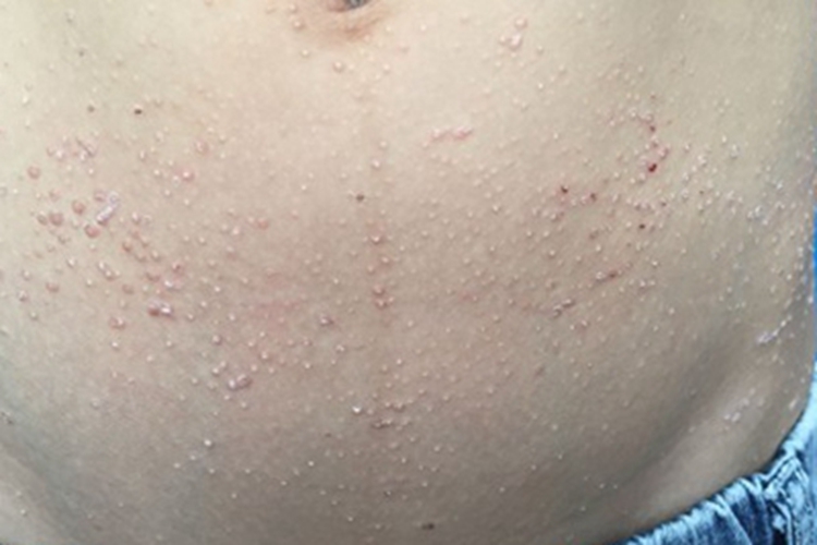 毛发红糠疹腹部丘疹图