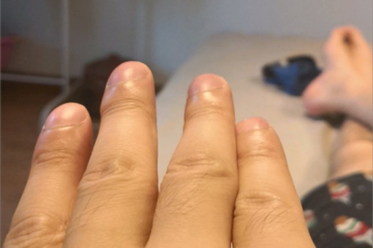 杵状指隆起图 杵状指隆起图