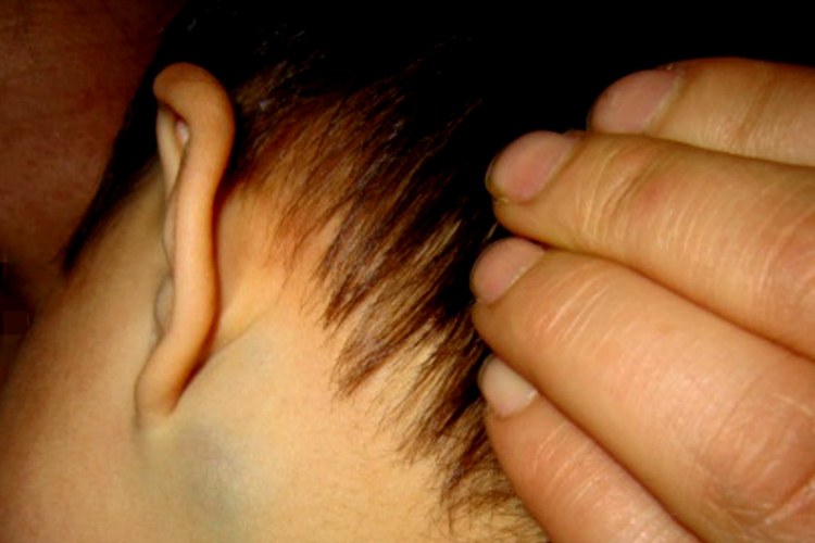 耳后海绵状血管瘤图