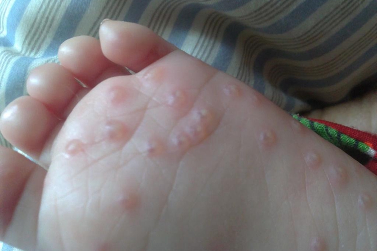 脚心汗疱疹水疱图
