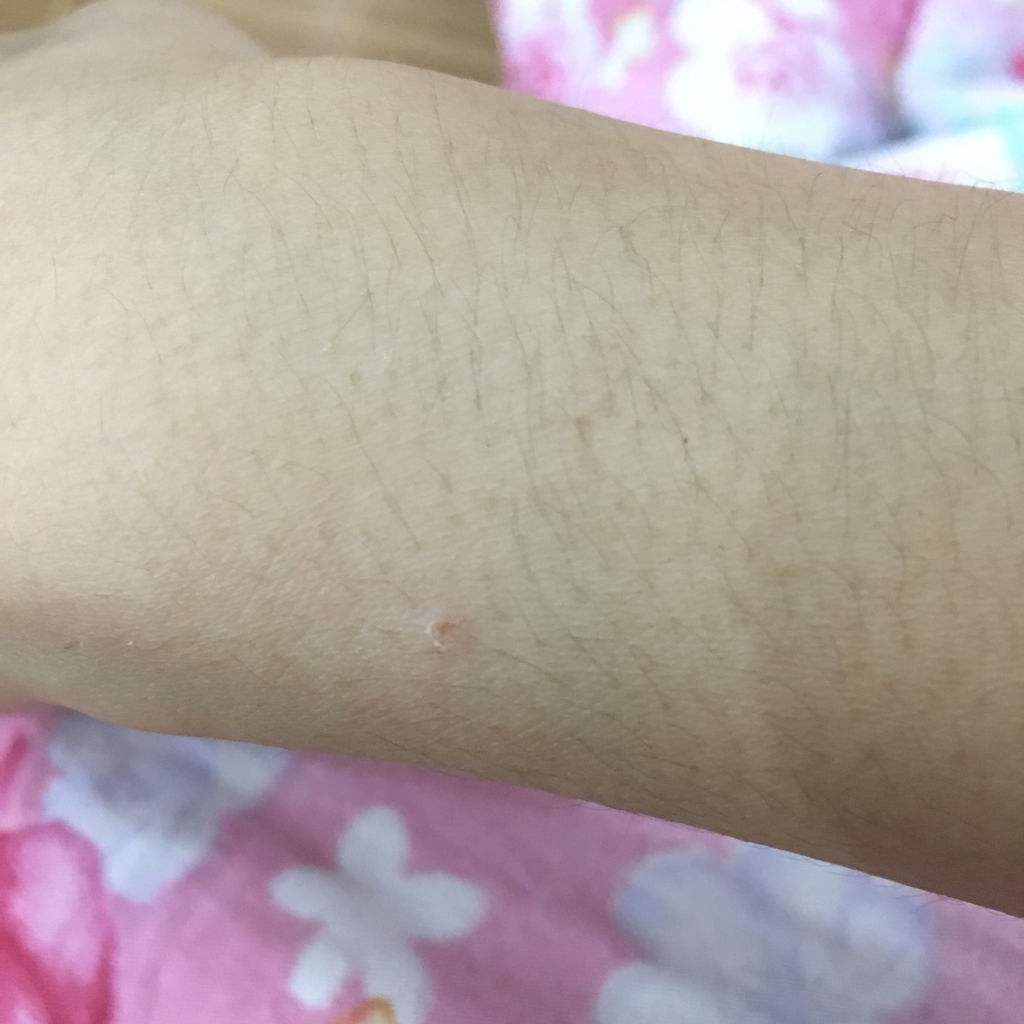 狂犬病暴露Ⅰ级图