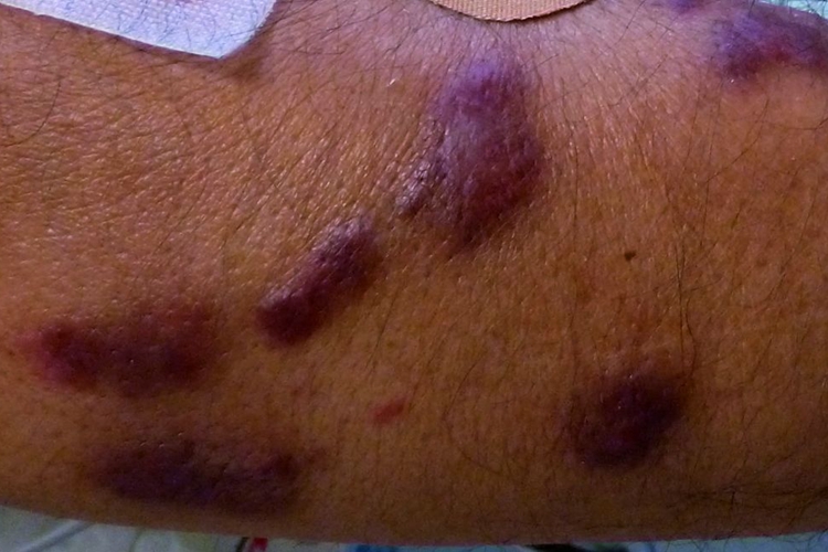 后期卡波西肉瘤图 后期卡波西肉瘤图