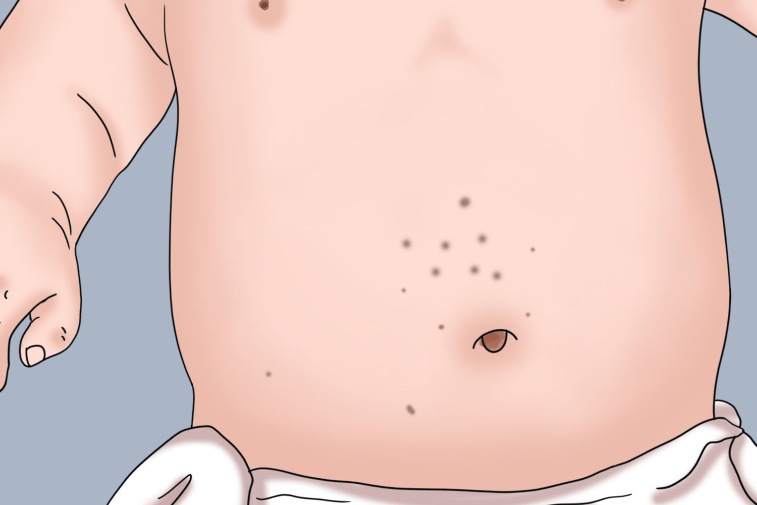 胸下面炎症后色素沉着图