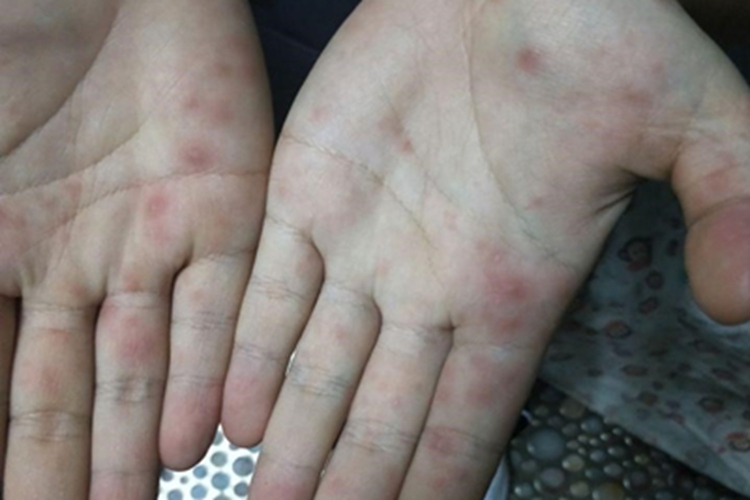 手足口病手部丘疹图