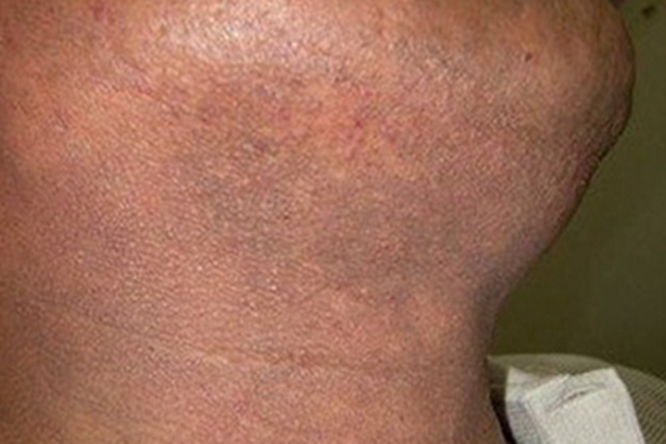 皮肤垢着病颈部皮肤发黑图