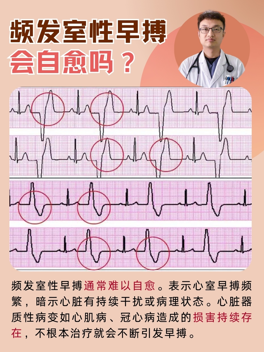 医生带你了解，频发室性早搏会自愈吗