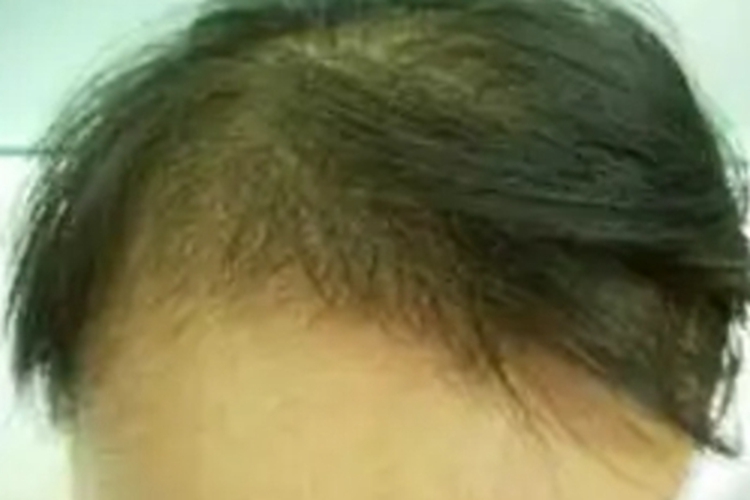 系统性红斑狼疮毛发干燥图