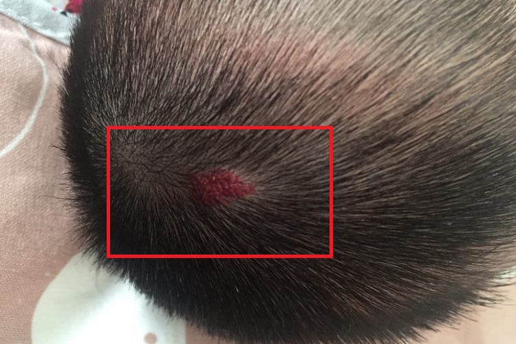 血管瘤头皮症状图