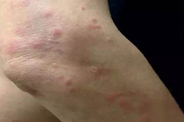 蚋叮咬引起的皮肤反应疙瘩图 蚋叮咬引起的皮肤反应疙瘩图