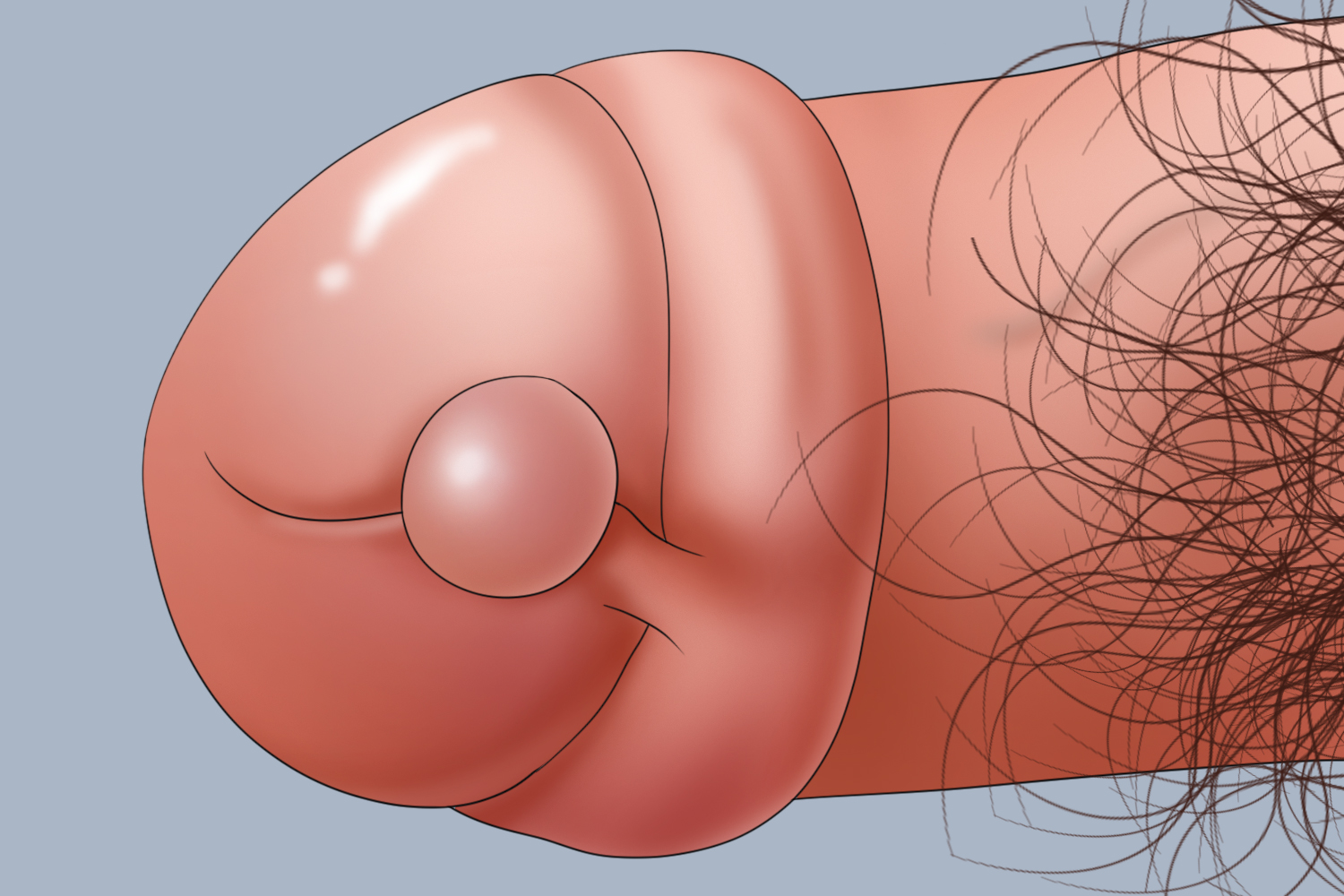 阴茎中线囊肿图 阴茎中线囊肿图