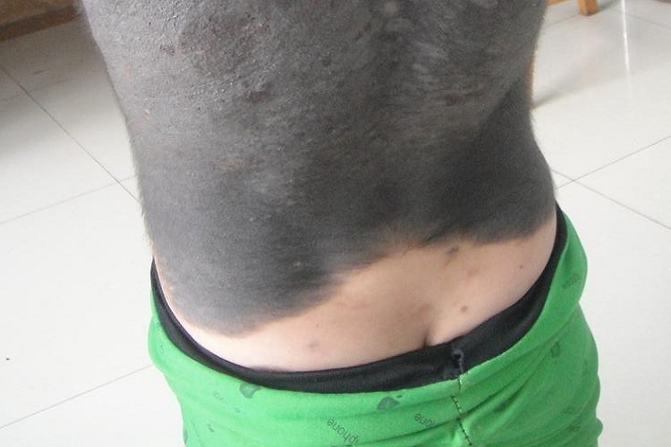 兽皮痣腰部症状图