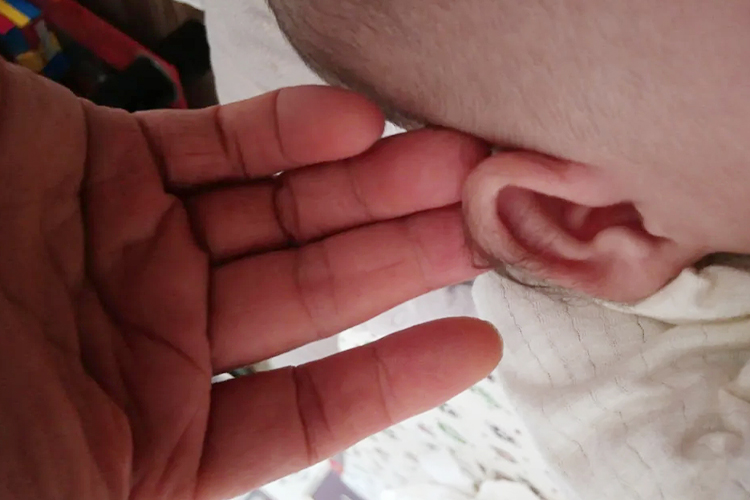 婴幼儿外耳道多毛症图