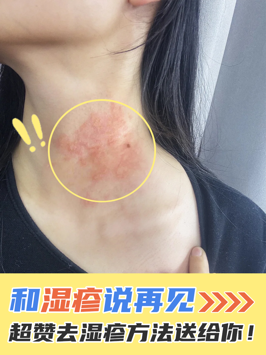 和湿疹说再见,超赞去湿疹方法送给你!