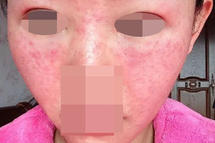 糖皮质激素依赖性皮炎红肿图