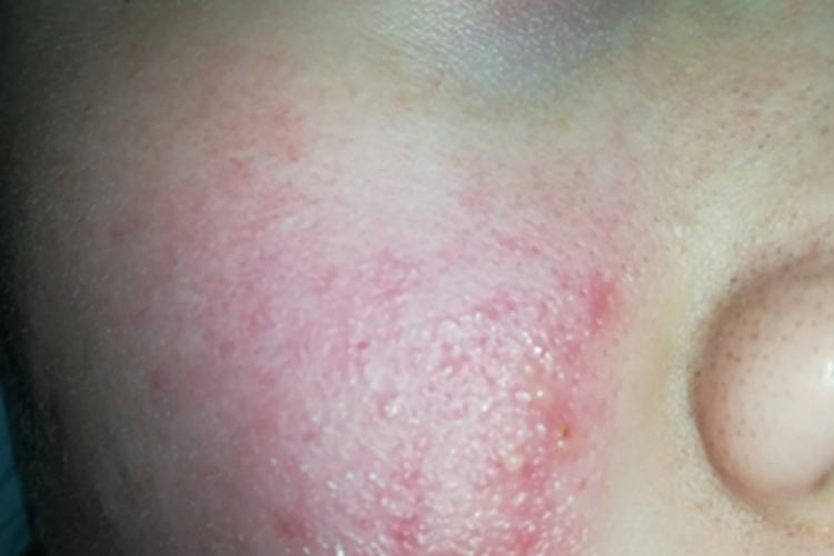 渗出性慢性单纯性糠疹面部症状图 渗出性慢性单纯性糠疹面部症状图