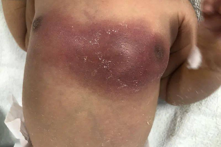 小孩蜂窝织炎图