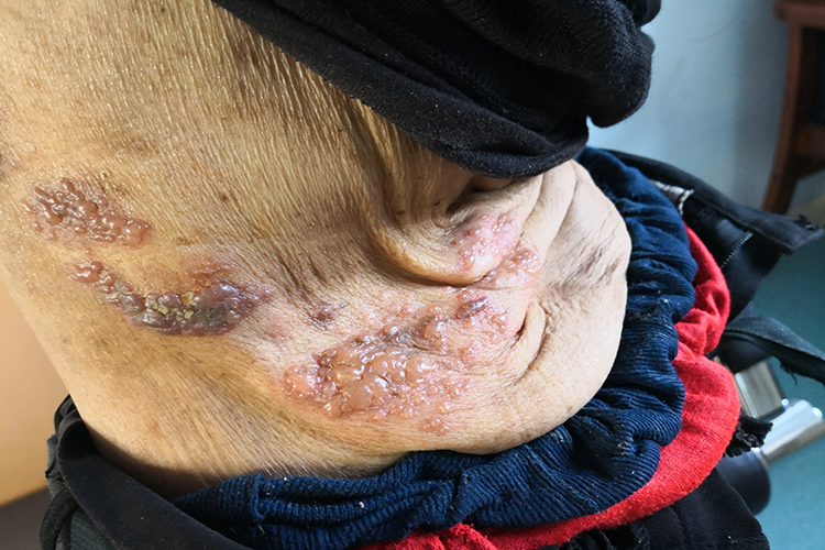 大疱型带状疱疹图