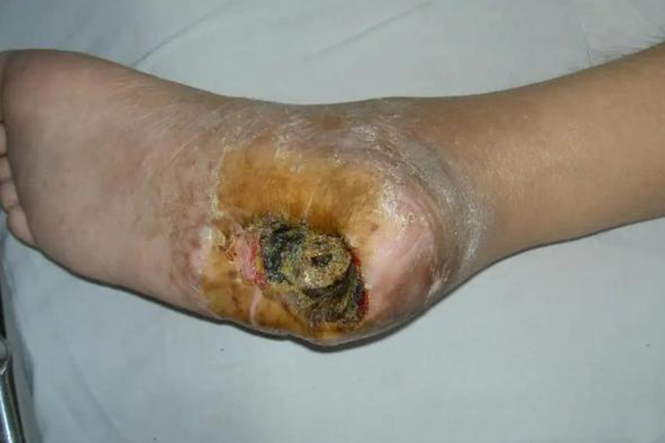 糖尿病患者干性坏疽图 糖尿病患者干性坏疽图